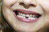 Chẩn đoán các vấn đề sức khỏe tâm thần ở trẻ em qua răng